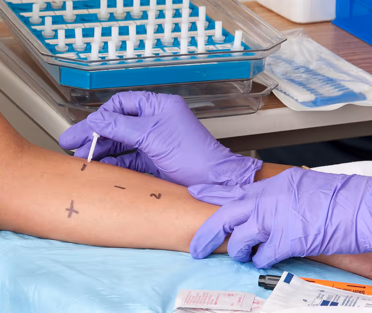 Arts met handschoenen voert allergiepriktests uit op een arm